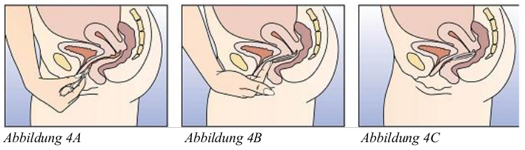 Abb.4A-4C. NuvaRing vaginales Freisetzungssystem